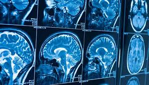 Brain Tumor Types & Treatment at Livasa Mohali - Comprehensive Care